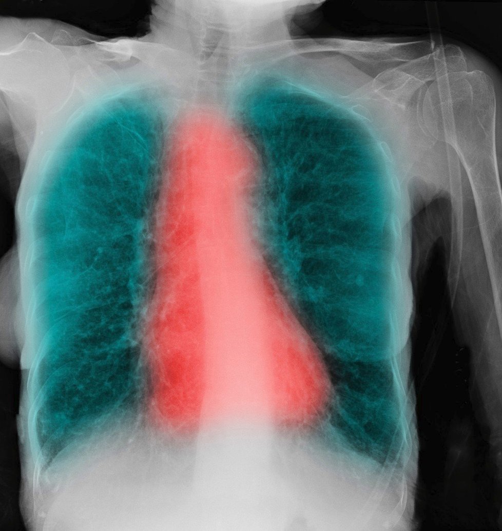 CHOPN ničivě poškozuje plíce. Nemoci lze přitom předejít.