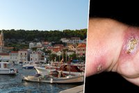 Kožní vředy jako suvenýr z Chorvatska: O zákeřné nemoci se příliš nemluví, přitom zabíjí