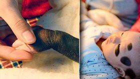 Dvouměsíční miminko Wu Zimiao z Číny se narodilo se vzácnou kožní nemocí. Má po celém těle velké pigmentové skvrny a kožní znaménka.