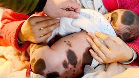 Dvouměsíční miminko Wu Zimiao z Číny se narodilo se vzácnou kožní nemocí.
