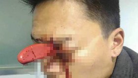 Číňanovi manželka zabodla nůž do oka. Jako zázrakem se mu nic vážnější nestalo.