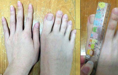 Číňanka se pyšní bizarní anomálií: Na nohou má »pařáty« dlouhé 5 cm