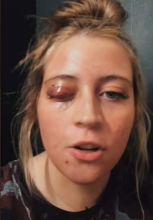 Mladou ženu náhle napadla čivava a utrhla jí oční víčko! Žal si léčí na TikToku