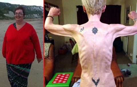 Jen kosti a kůže! Z morbidně obézní ženy se stala anorektička, váží 32 kilo