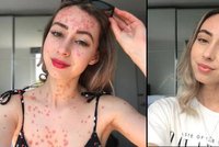 Someliérka (25) má kůži pokrytou strupy: Proti onemocnění bojuje odvážnými fotkami