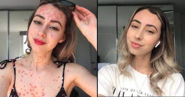 Someliérka (25) má kůži pokrytou strupy: Proti onemocnění bojuje odvážnými fotkami