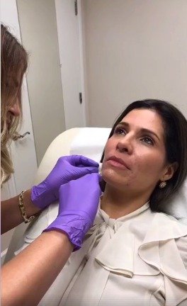 Claudia Sierra si nechala do obličeje píchnout injekce botoxu.