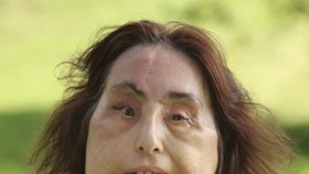 Američanka Connie Culp je první žena na světě, které byla provedena transplantace tváře v takovém rozsahu.