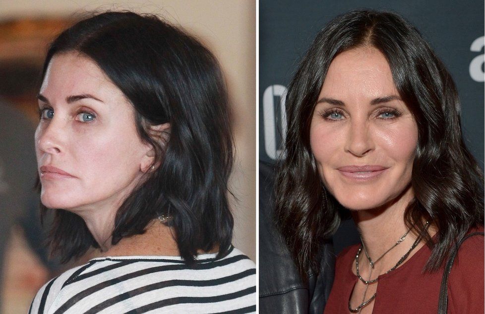 Hvězda seriálu Přátelé Courteney Cox (52) má v oblibě botox. Jednou za čas se objeví na veřejnosti s nápadně oteklým obličejem. Přiznala se, že jednou to s botoxovými injekcemi přehnala a nemohla vůbec s obličejem hýbat. Očividně ji to ale neodradilo a k mladistvějšímu vzhledu si stále dopomáhá.