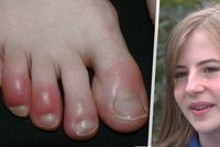 Covidové prsty jako vážný příznak u dětí: Sophii (13) ničí život už od podzimu