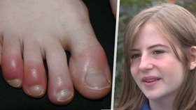 Covidové prsty jako vážný příznak u dětí: Sophii (13) ničí život už od podzimu