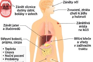 Crohnova choroba