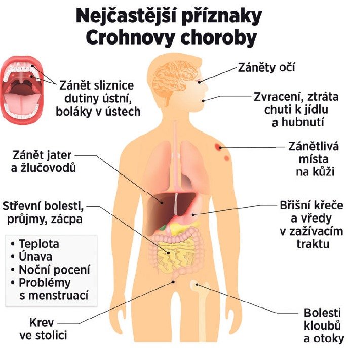 Crohnova choroba