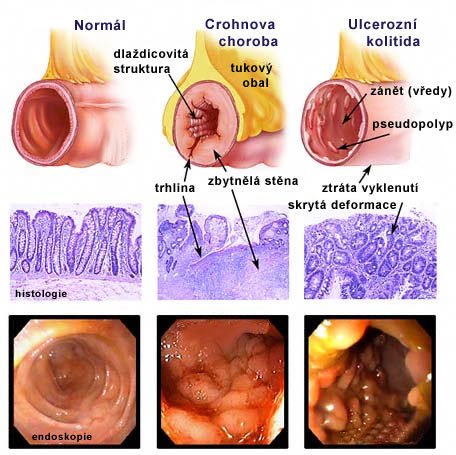 Co je Crohn