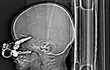 1) Američan Nicholas Holderman (17 měsíců) upadl při hraní na klíče a ty mu pronikly skrz oční důlek až do mozku. Lékařům se naštěstí podařilo klíče vyoperovat, aniž by poškodili mozek nebo zrak.