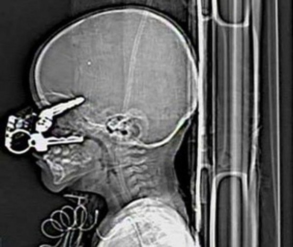 1) Američan Nicholas Holderman (17 měsíců) upadl při hraní na klíče a ty mu pronikly skrz oční důlek až do mozku. Lékařům se naštěstí podařilo klíče vyoperovat, aniž by poškodili mozek nebo zrak.
