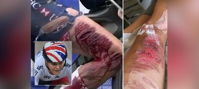 Anglická cyklistka Lauren Dohan si na MS juniorek přivodila ošklivé zranění. Po pádu měla tak rozřezanou nohu, že po dojetí do cíle musela na dvě hodiny pod kudlu.