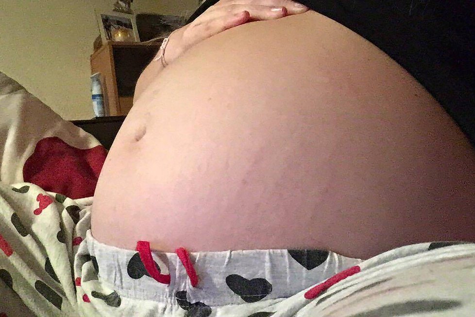 Takhle vypadalo její břicho s cystou, která jí tlačila na dělohu.