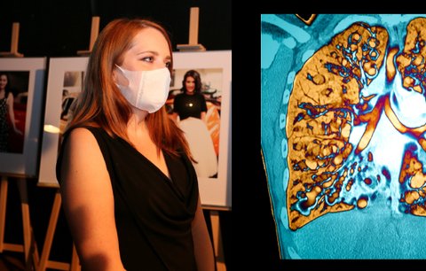Markéta (32) se narodila s cystickou fibrózou: Nemocné dusí hleny, choroba ničí plíce