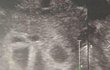 Snímek z ultrazvuku, který vše prozradil. V bříšku mladé mamince netlouklo jedno srdíčko, ale hned pět!