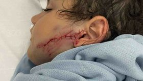 Dante Skordas (6) utrpěl vážná poranění na obličeji poté, co ho napadl pitbul.