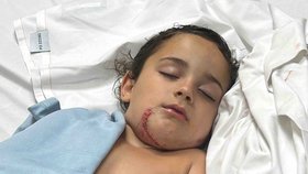 Dante Skordas (6) utrpěl vážná poranění na obličeji poté, co ho napadl pitbul.