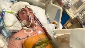 Davey Bauer si zničil vapováním plíce, život mu zachránily prsní implantáty.