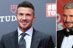 Záhada čela Davida Beckhama: Byl na botoxu?!