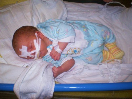 Davídka brzo po narození čekala plastická operace.
