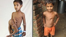 Malému Deepaku Kumarovi už nohy z břicha odoperovali