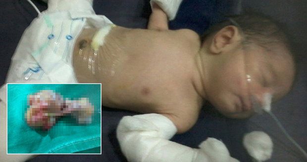 Chlapeček se narodil »těhotný«: Z břicha mu odstranili nevyvinutého bratříčka 