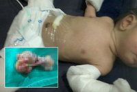 Chlapeček se narodil »těhotný«: Z břicha mu odstranili nevyvinutého bratříčka