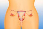 Nádory v děloze v průběhu života trápí až 40 % žen.