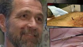 Nešikovný americký kutil Hennis září štěstím: Přežil zásah deseticentimetrovým hřebíkem do srdce