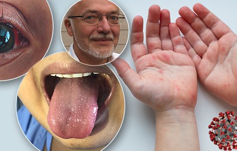 Děti ohrožuje pocovidová nemoc: Léčba musí být rychlá, varuje špičkový pediatr!