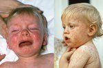 Spalničky se šíří Českem i kvůli rodičům, kteří své děti odmítají nechat očkovat (ilustrační foto)