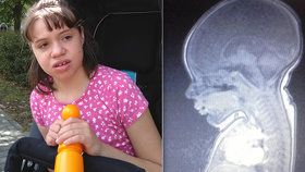 Vanda (11) se narodila s dětskou mozkovou obrnou.
