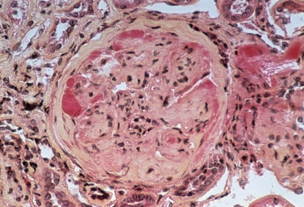 Diabetolog: Cukrovka se objevuje už u velmi mladých lidí