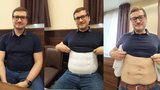 Úleva pro rodičky, kýlaře i pupkáče: Lékaři v Brně umí šetrně spravit povadlé břicho