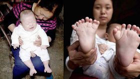 Čínský chlapec se narodil s 31 prsty.