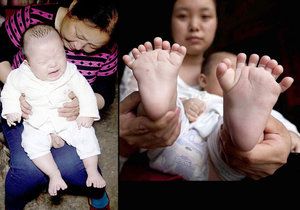 Čínský chlapec se narodil s 31 prsty.