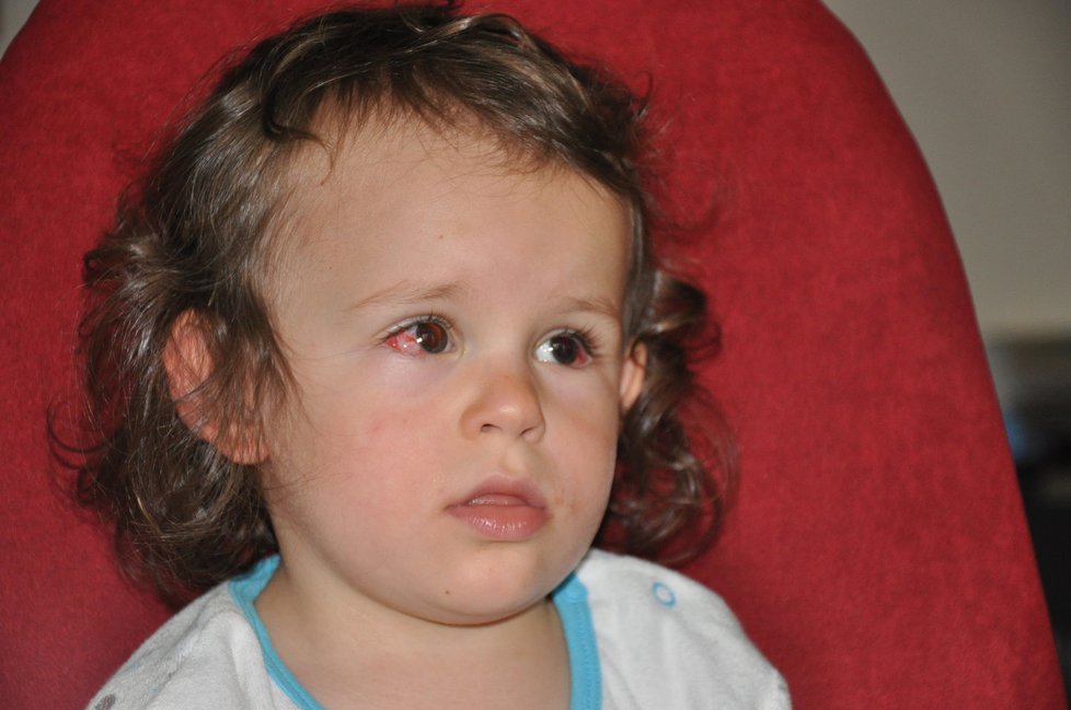 Amélie s retinoblastomem - nádorem oka