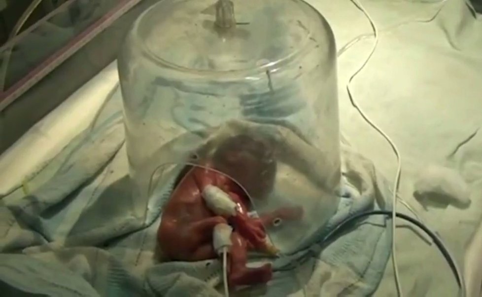 Holčička se narodila ve 24. týdnu těhotenství.