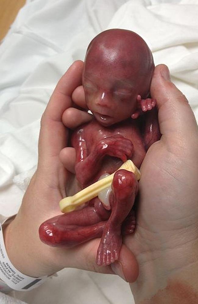 V jiných zemích jsou potraty dovoleny i v 19. týdnu těhotenství. Fotografka Alexis se rozhodla ukázat, jak miminko tou dobou vypadá. Sama totiž předčasně porodila, dítě zemřelo.