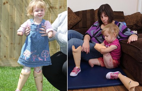 Tříletá holčička na protézách: Už zase chodím!