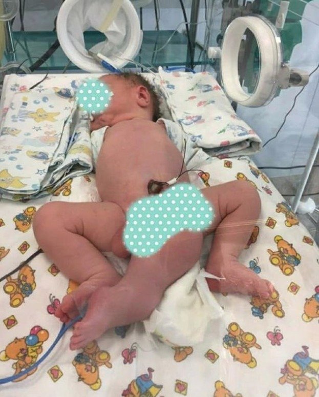 Dítě se narodilo znetvořené. Lékaři mu díky několika operacím zachránili život.