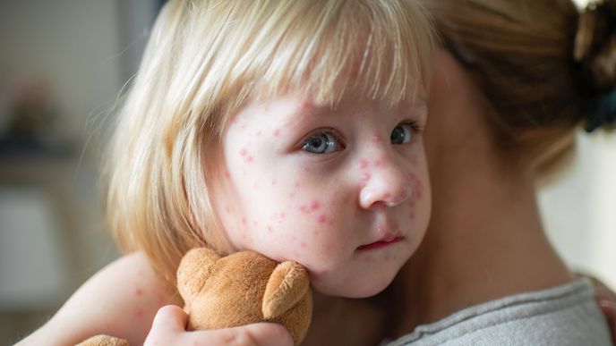 Velký přehled nemocí s vyrážkou u dětí: Jak poznat neštovice, ekzémy i meningitidu Velký přehled nemocí s vyrážkou u dětí: Jak poznat neštovice, ekzémy i meningitidu