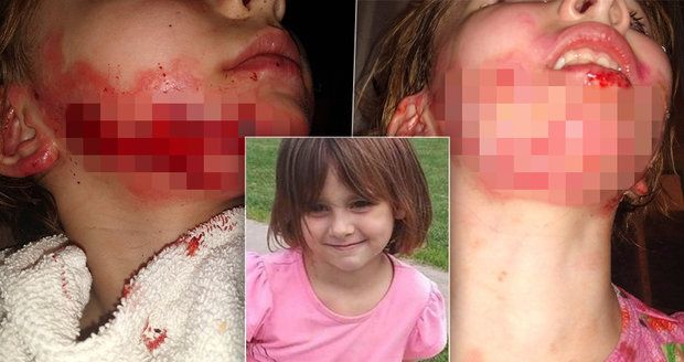Holčička (6) skončila s těžkými popáleninami na obličeji: Způsobila jí je dezinfekce!