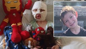 Šestiletý Dominick Krankall utrpěl vážné popáleniny poté, co po něm osmiletý chlapec od sousedů hodil zapálený tenisový míček.