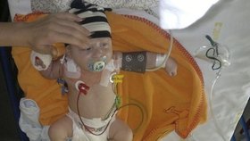 Pár týdnů po narození musel Dominik do nemocnice, kde byl připojen na přístroje.